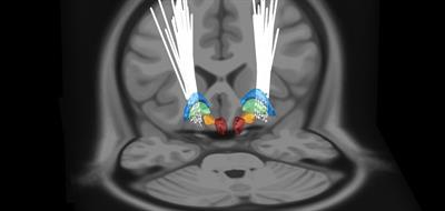 A localized pallidal physiomarker in Meige syndrome